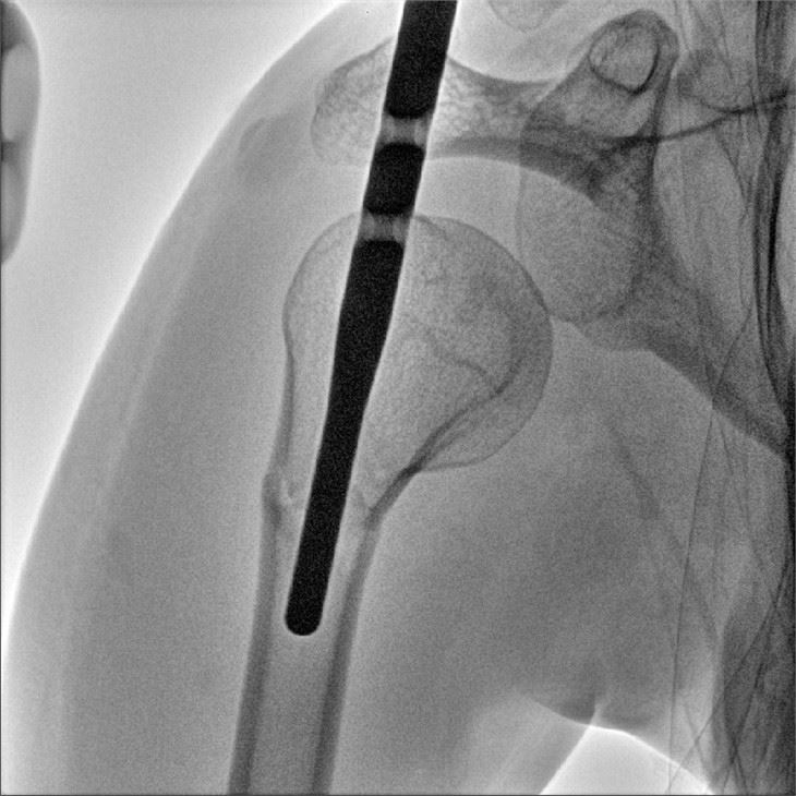 Radiographic C Arm Machine